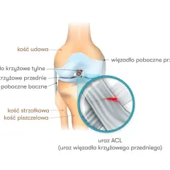 Anatomia kolana z zaznaczonym urazem ACL (przedniego więzadła krzyżowego). Widoczna jest ruptura więzadła.