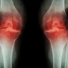 RTG kolan z zaznaczonymi na czerwono obszarami bólu, wskazującymi na potrzebę osteotomii kolana.