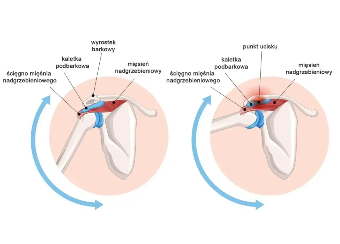 Anatomia barku: prawidłowe położenie ścięgna mięśnia nadgrzebieniowego i kaletki podbarkowej w porównaniu do ucisku na obojczyk i wyrostek barkowy.