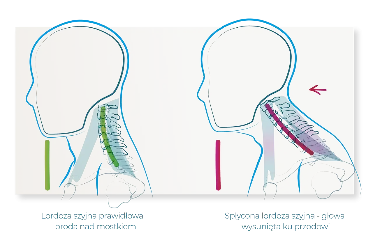 Spondyloza szyjna - objawy, badania i leczenie, które ma sens