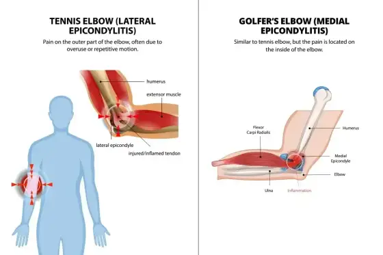 Staw łokciowy - anatomia, ruch i stabilność. Kiedy boli?