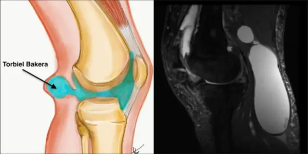 Ilustracja anatomiczna i rezonans magnetyczny ukazują torbiel Bakera w dole podkolanowym, wypełnioną płynem.