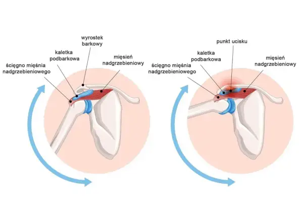 Anatomia barku: prawidłowe położenie ścięgna mięśnia nadgrzebieniowego i kaletki podbarkowej w porównaniu do ucisku na obojczyk i wyrostek barkowy.
