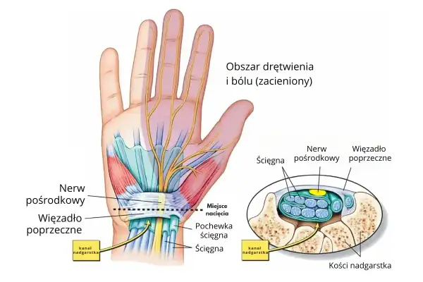 Anatomia dłoni: nerw pośrodkowy, ścięgna i więzadło poprzeczne w kanale nadgarstka. Ilustracja pokazuje obszar drętwienia i bólu.