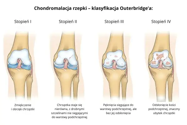 Klasyfikacja Outerbridge'a pokazuje cztery stopnie chondromalacji rzepki: od zmiękczenia chrząstki (stopień I) do odsłonięcia kości (stopień IV).